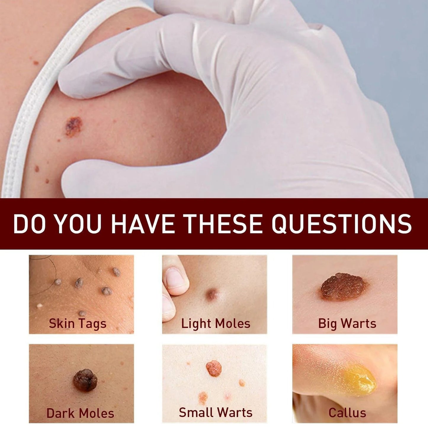 Best Sellers - Tags & Moles Remover——10 pcs (FREE SHIPPING)