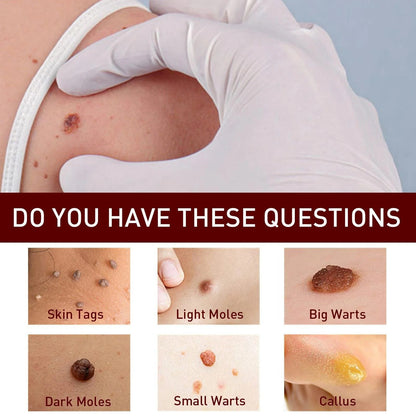 Best Sellers - Tags & Moles Remover——10 pcs (FREE SHIPPING)